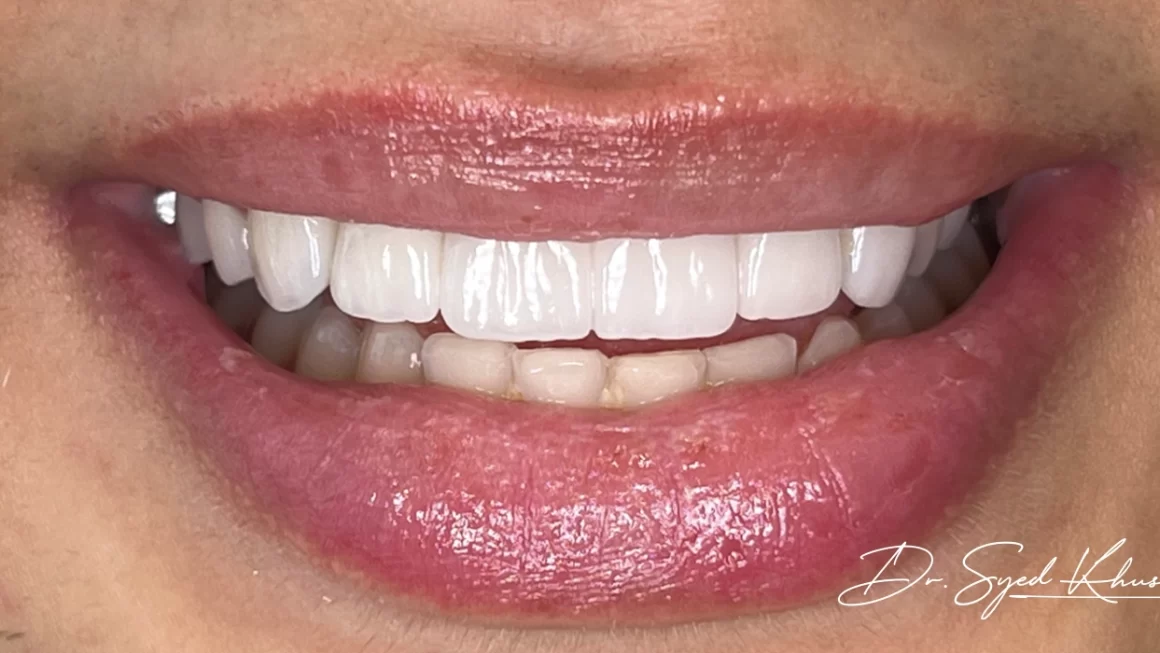 What Treatments Are Included In A Hollywood Smile Package?