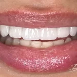 What Treatments Are Included In A Hollywood Smile Package?