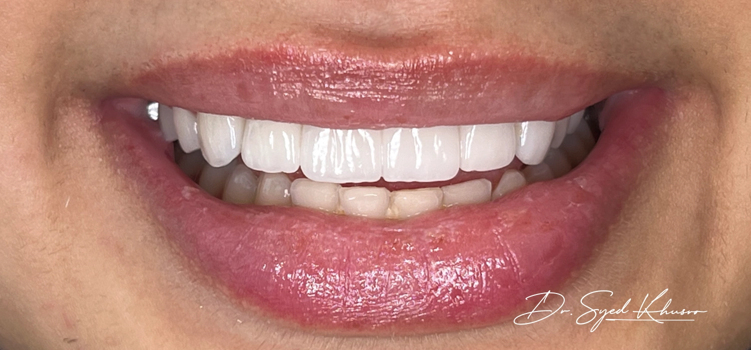 What Treatments Are Included In A Hollywood Smile Package?